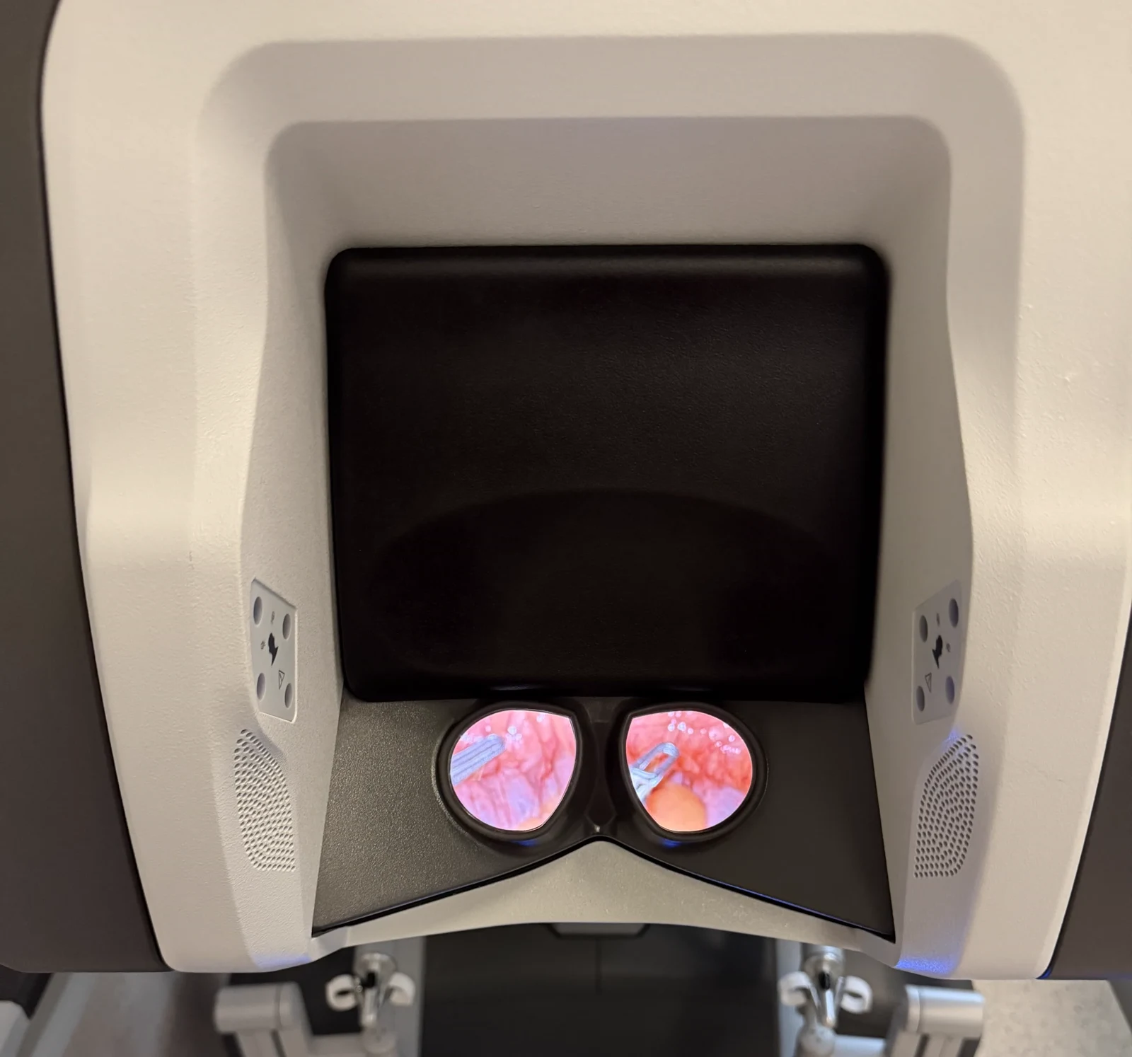 Da Vinci surgical console showing the endoscopic view through the eyepieces during a procedure